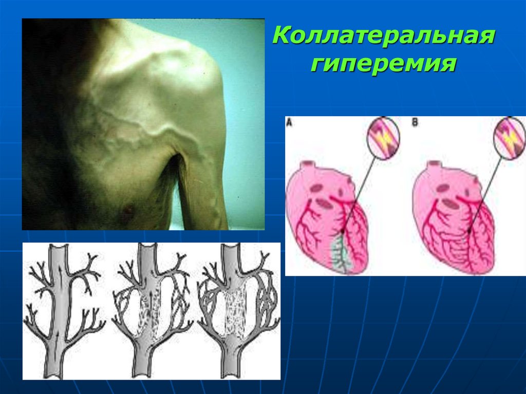 Коллатеральная гиперемия