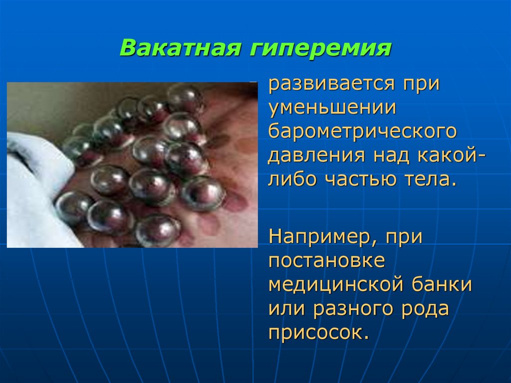 Вакатная гиперемия