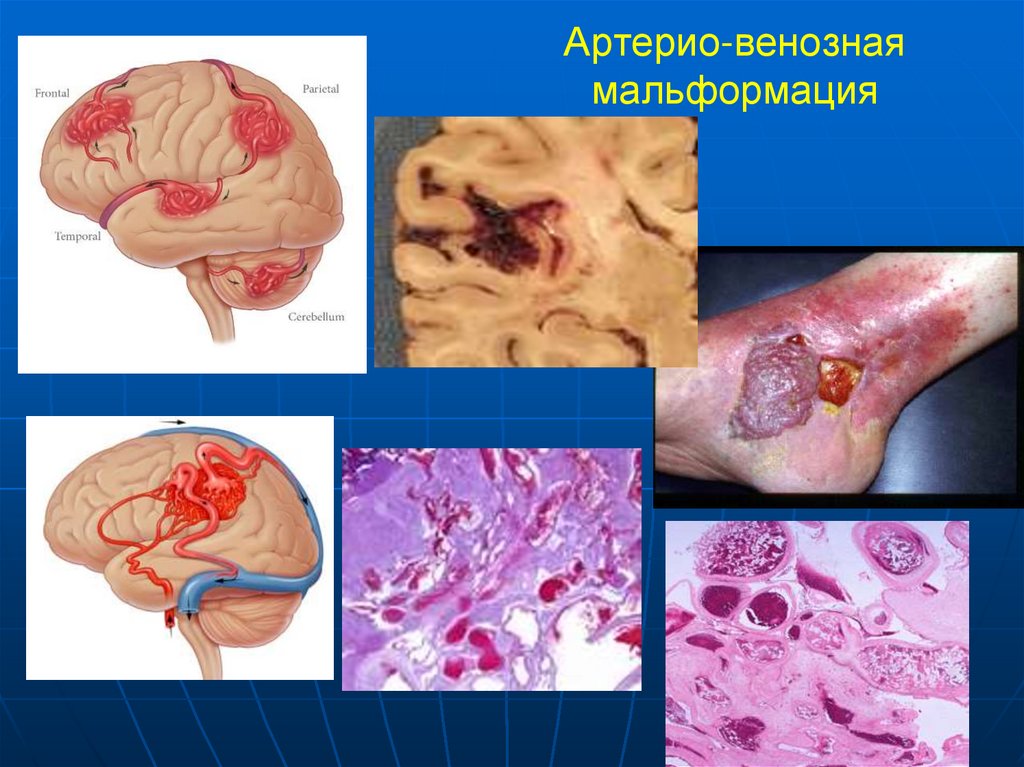 Артерио-венозная мальформация