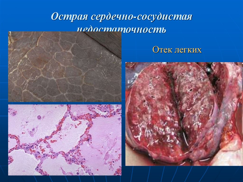 Острая сердечно-сосудистая недостаточность