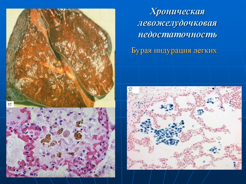 Хроническая левожелудочковая недостаточность