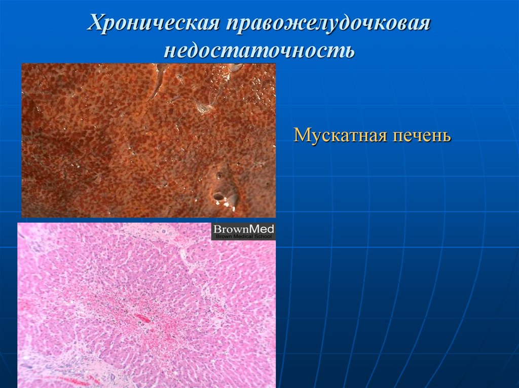 Хроническая правожелудочковая недостаточность