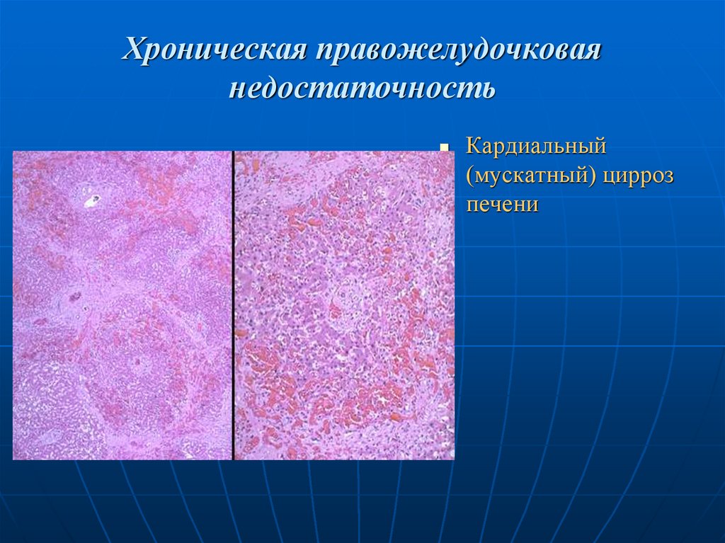 Хроническая правожелудочковая недостаточность