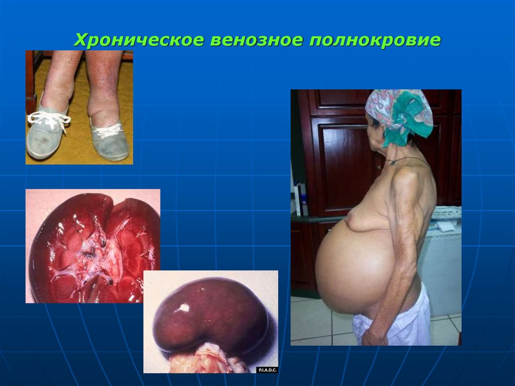 Хроническое венозное полнокровие