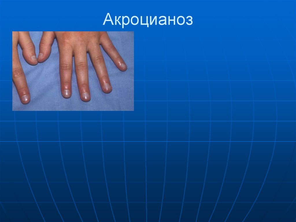 Акроцианоз