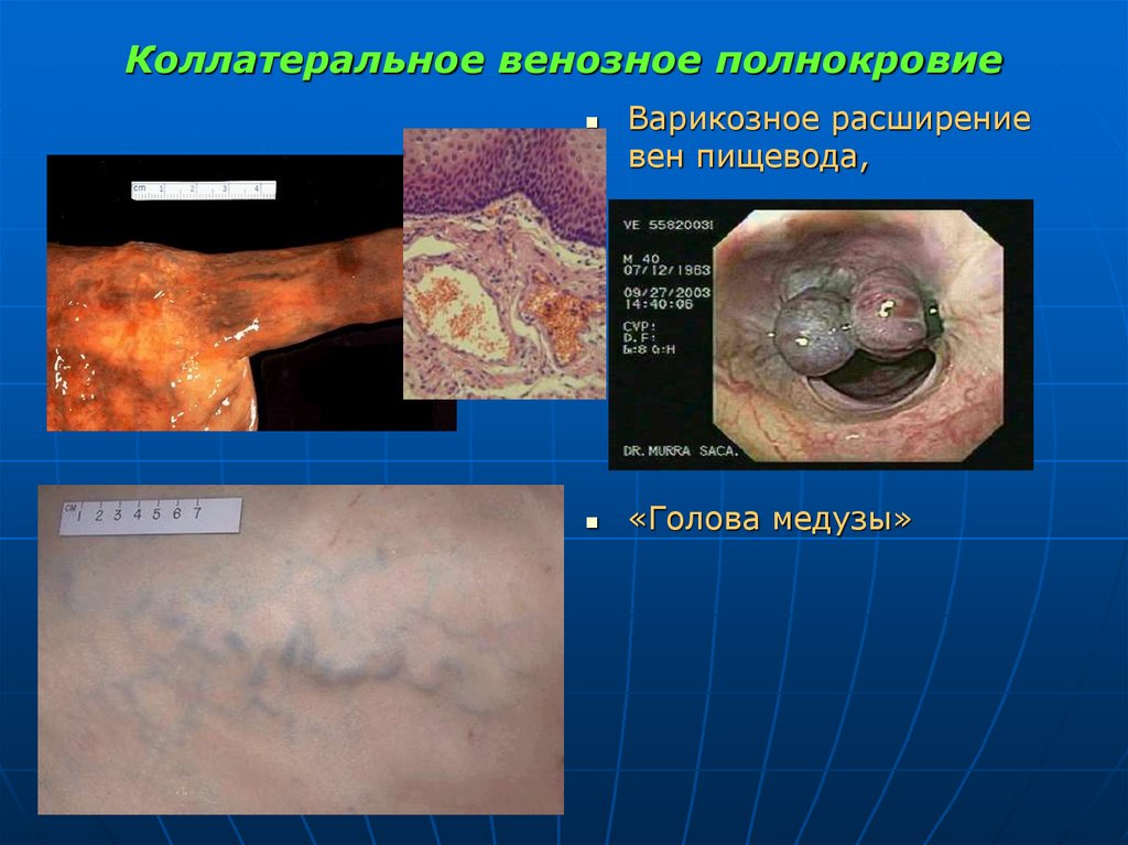 Коллатеральное венозное полнокровие