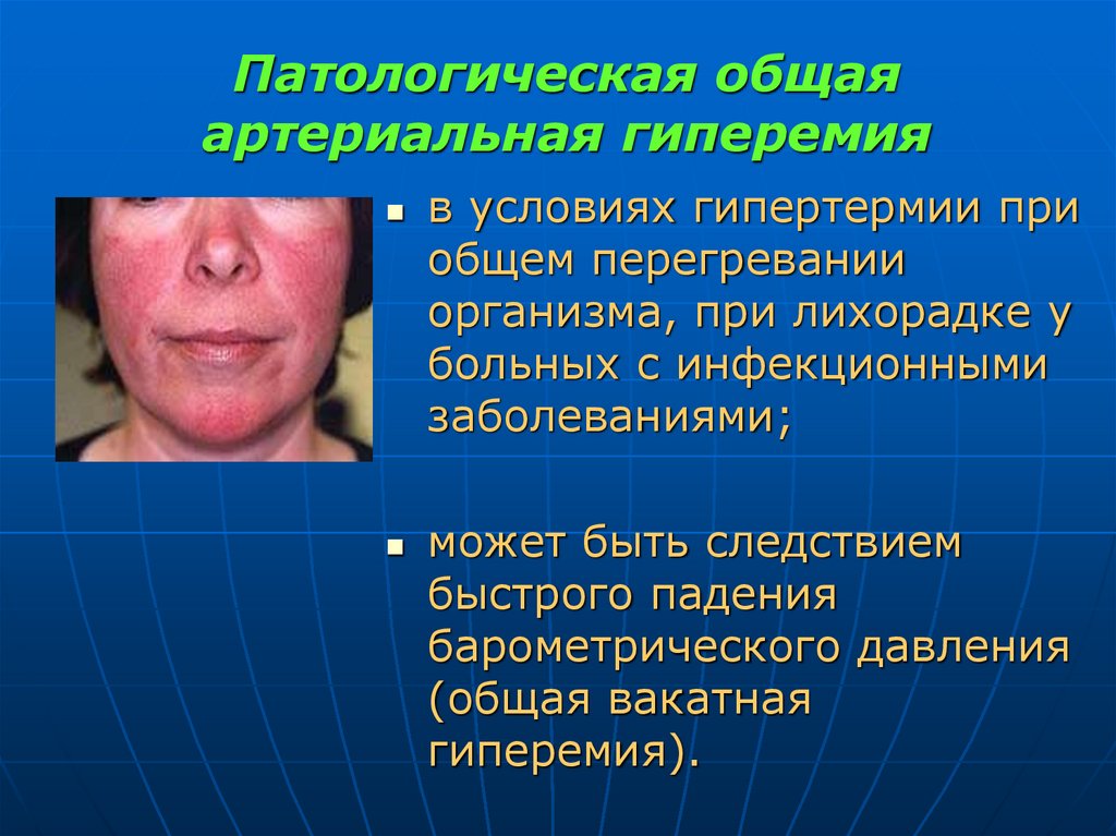Патологическая общая артериальная гиперемия