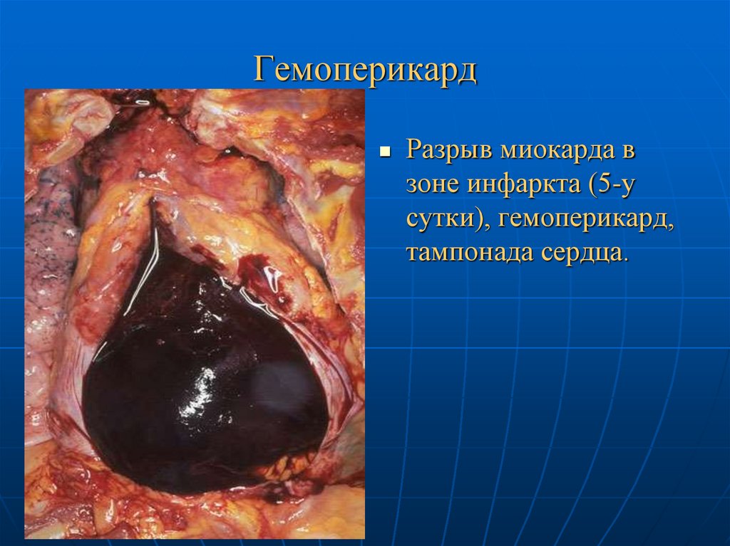 Гемоперикард