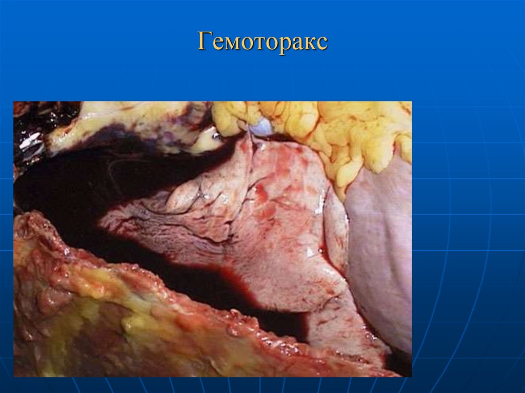 Гемоторакс
