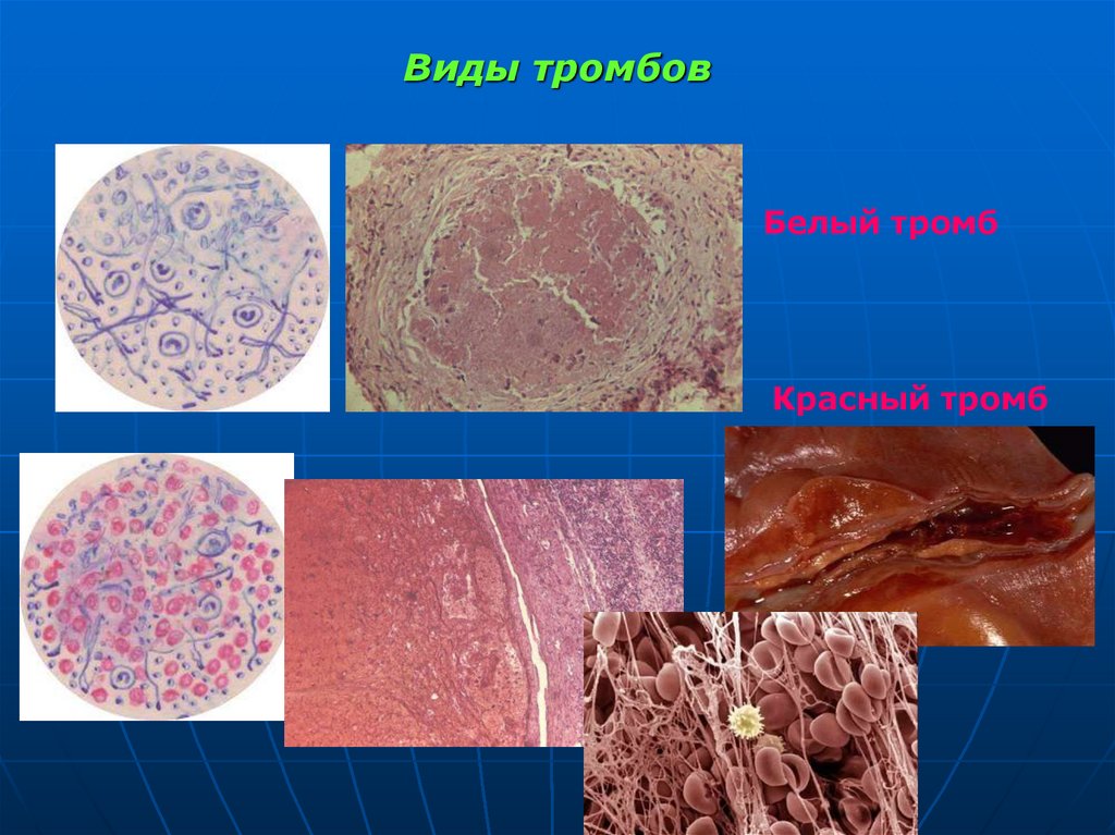 Виды тромбов