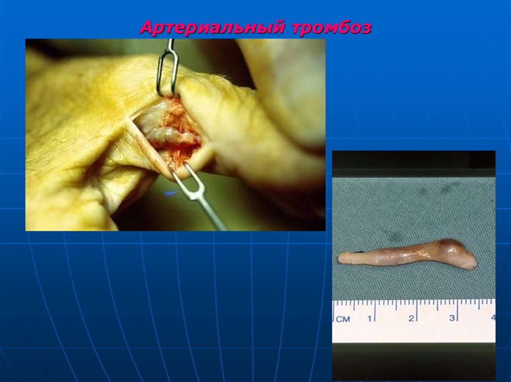 Артериальный тромбоз