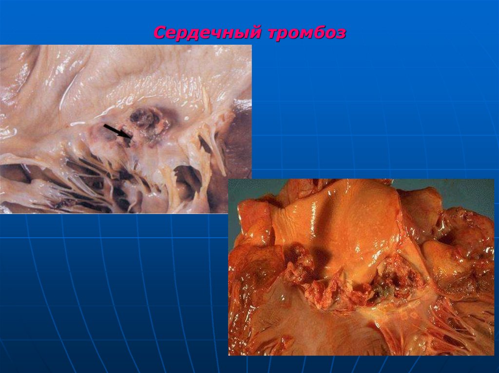 Сердечный тромбоз