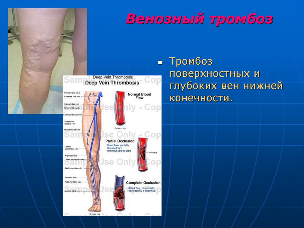 Венозный тромбоз