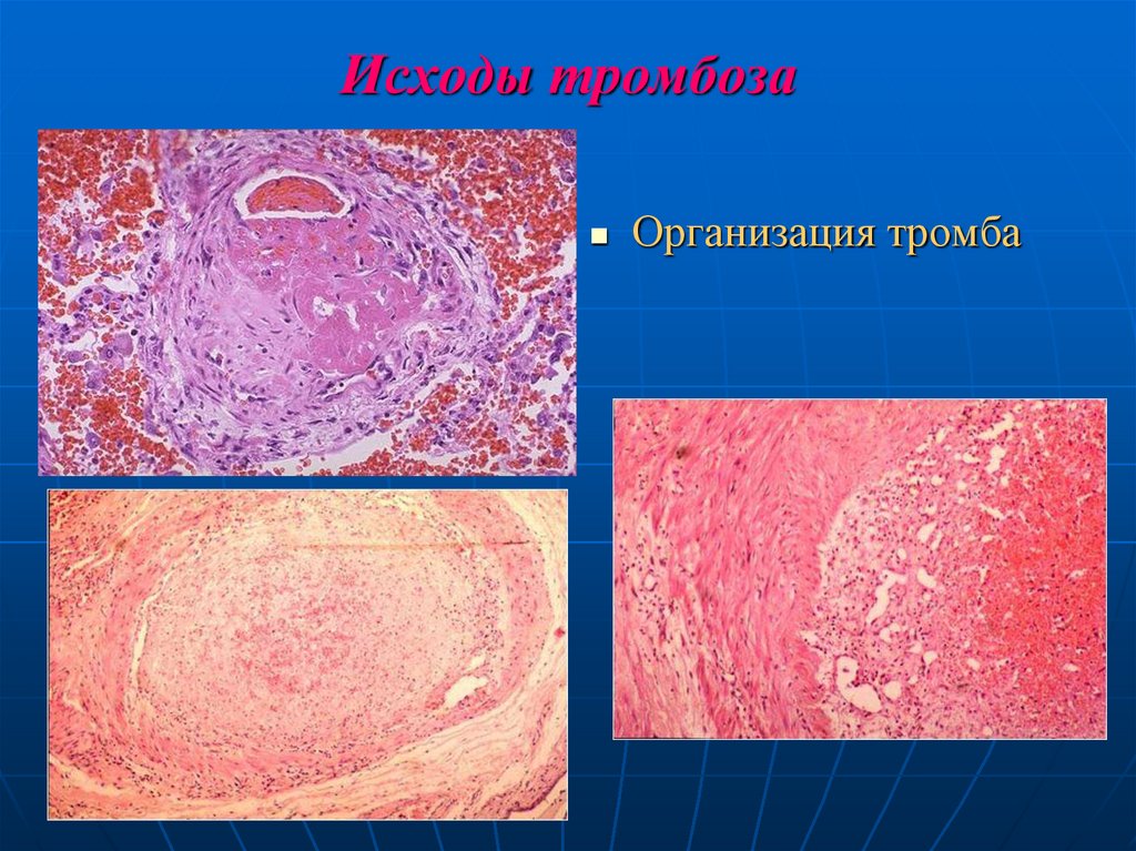 Исходы тромбоза