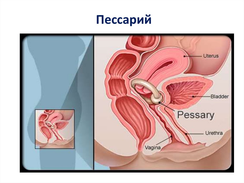Пессарий