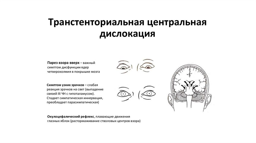 Транстенториальная центральная дислокация