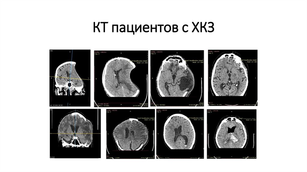КТ пациентов с ХКЗ