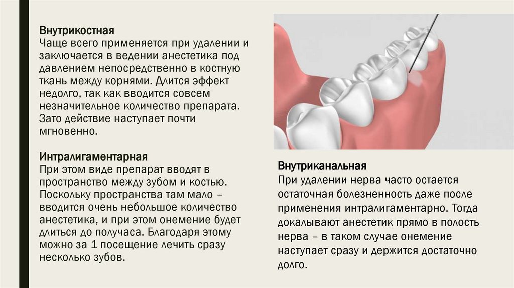 Внутрикостная Чаще всего применяется при удалении и заключается в ведении анестетика под давлением непосредственно в костную