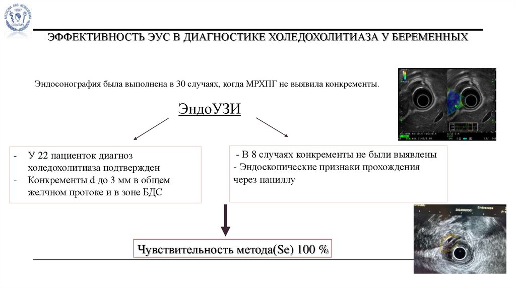 ЭФФЕКТИВНОСТЬ ЭУС в диагностике холедохолитиаза у беременных