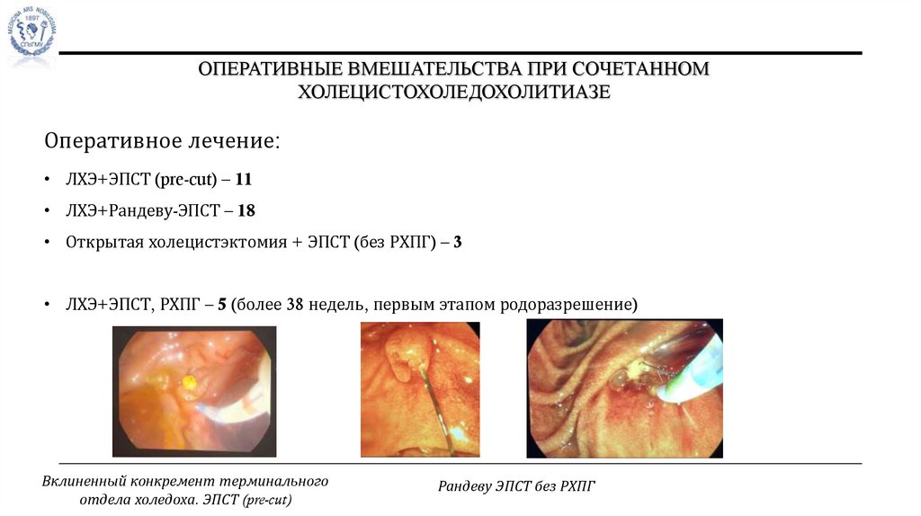 Оперативные вмешательства при сочетанном холецистохоледохолитиазе
