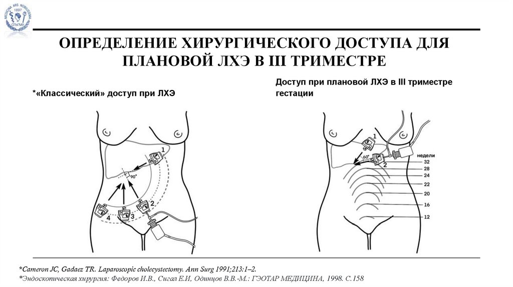 Определение хирургического доступа для плановой ЛХЭ в III триместре