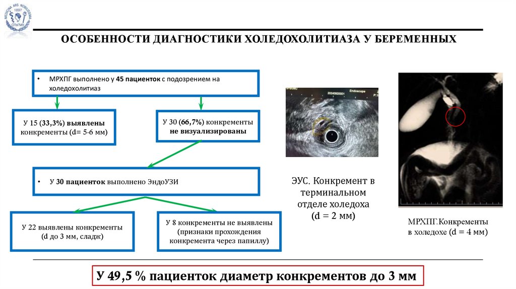 Особенности диагностики холедохолитиаза у беременных