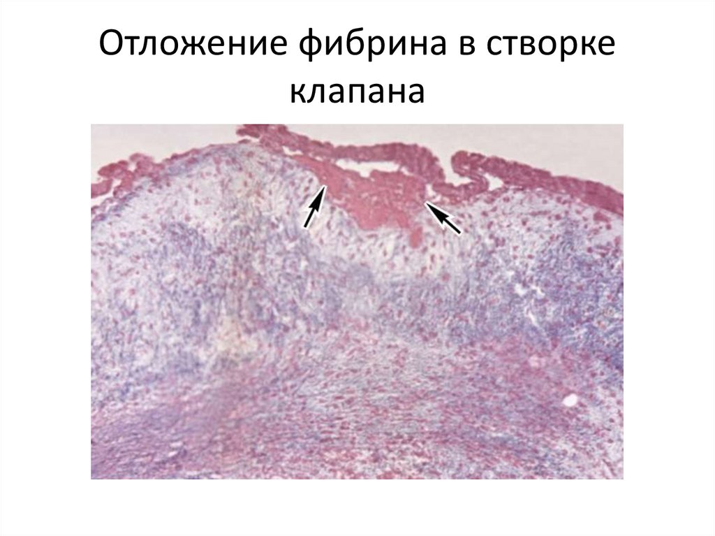 Отложение фибрина в створке клапана