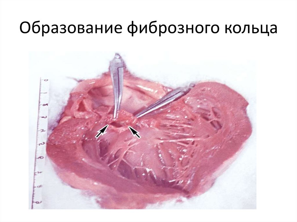 Образование фиброзного кольца