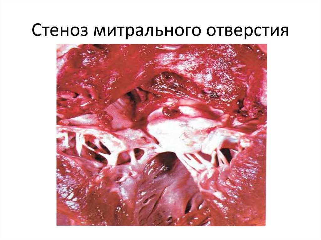 Стеноз митрального отверстия