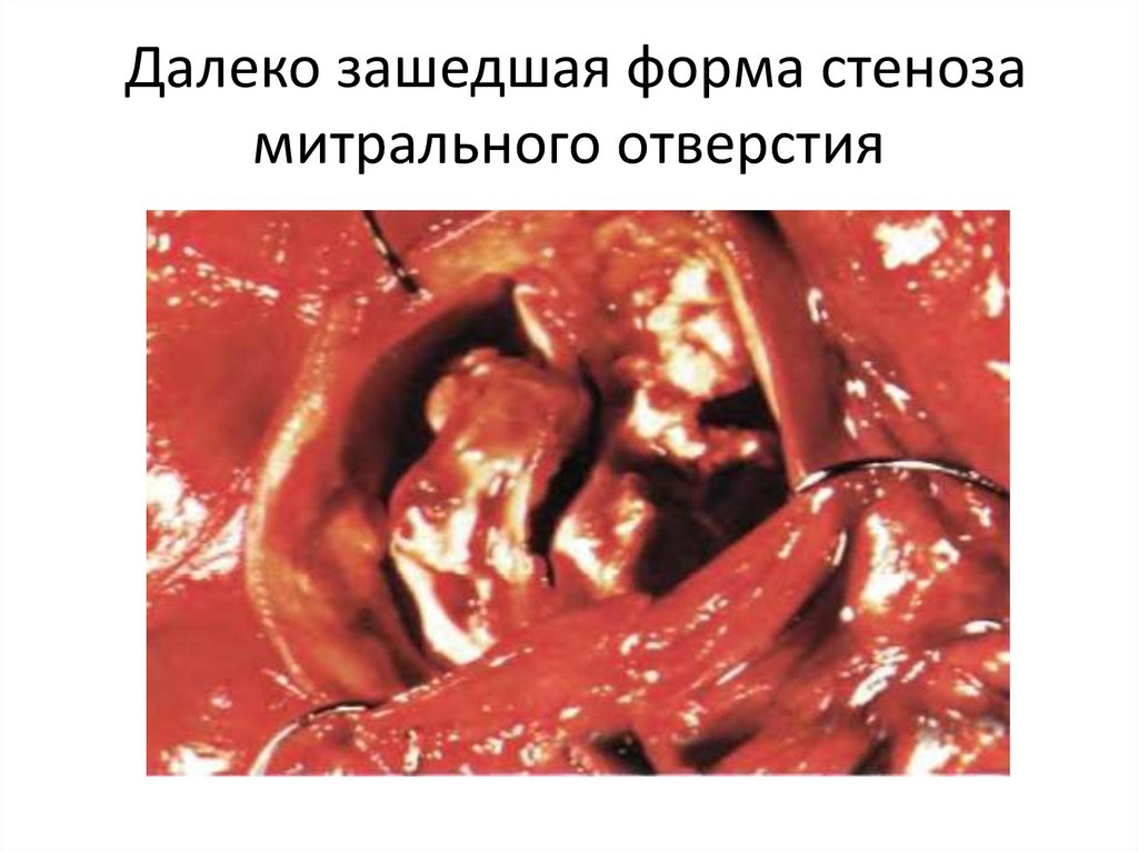 Далеко зашедшая форма стеноза митрального отверстия