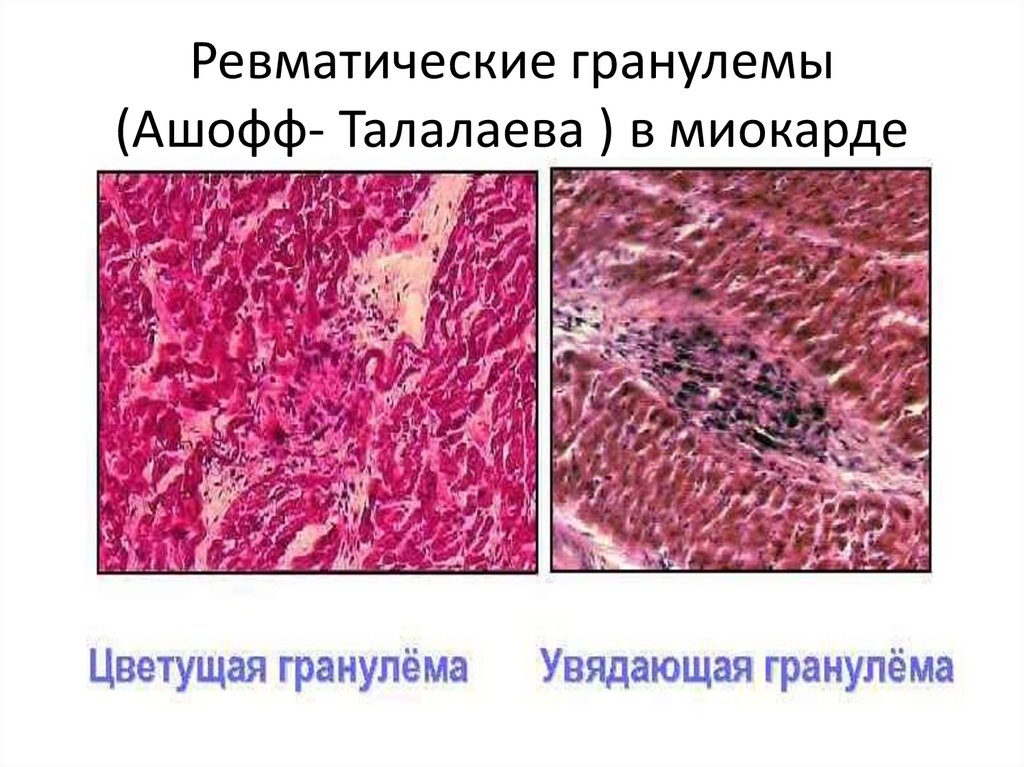 Ревматические гранулемы (Ашофф- Талалаева ) в миокарде