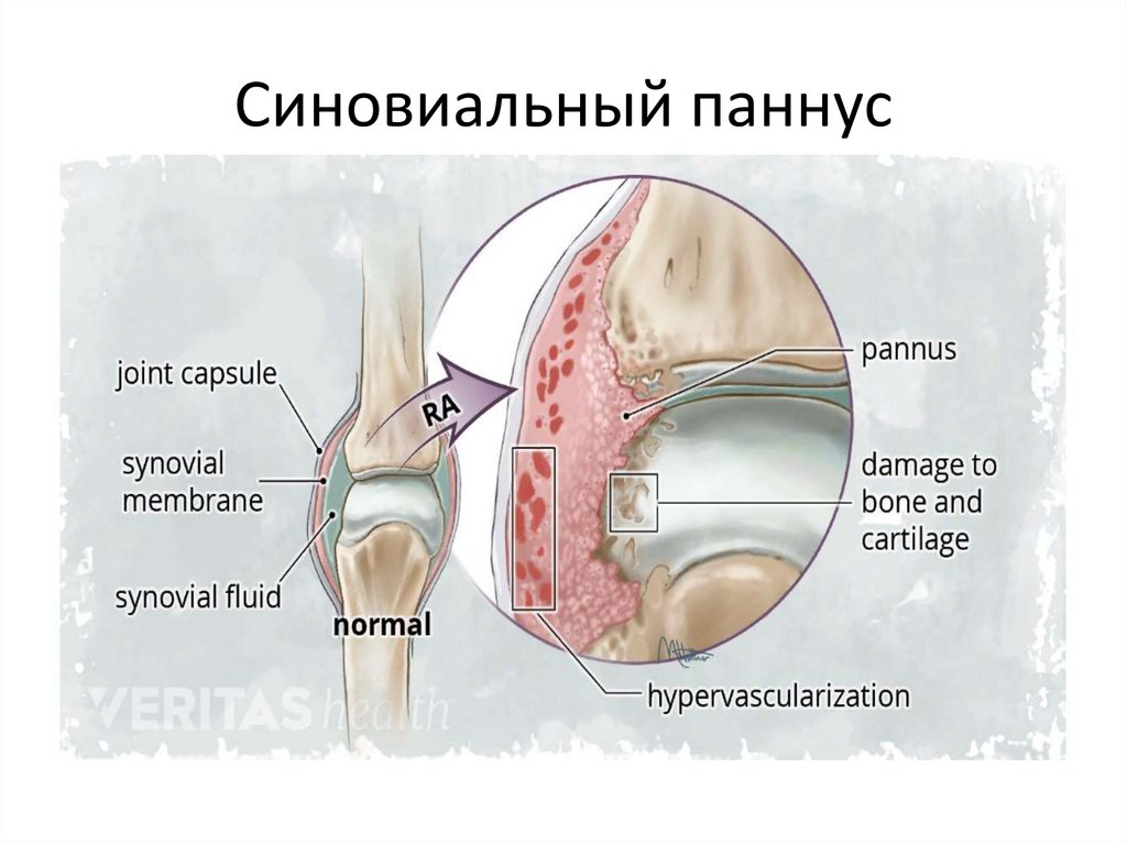 Синовиальный паннус