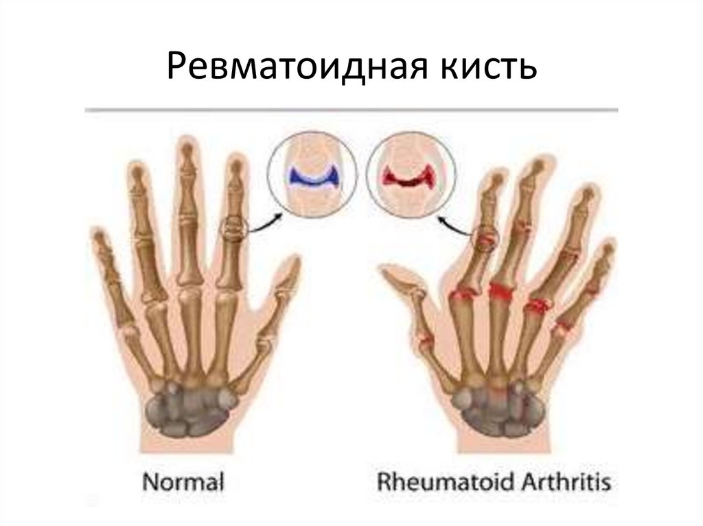 Ревматоидная кисть
