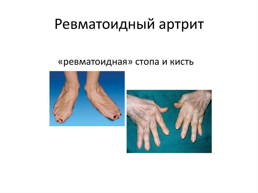 Ревматоидный артрит