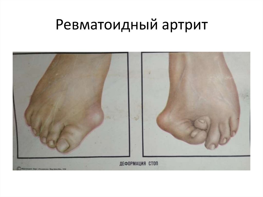 Ревматоидный артрит