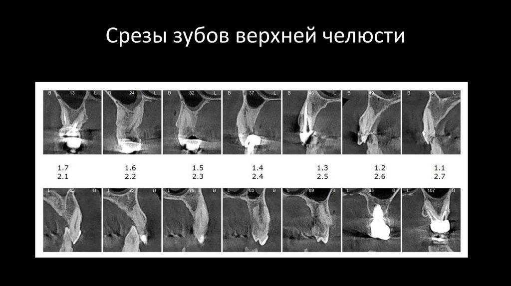 Срезы зубов верхней челюсти