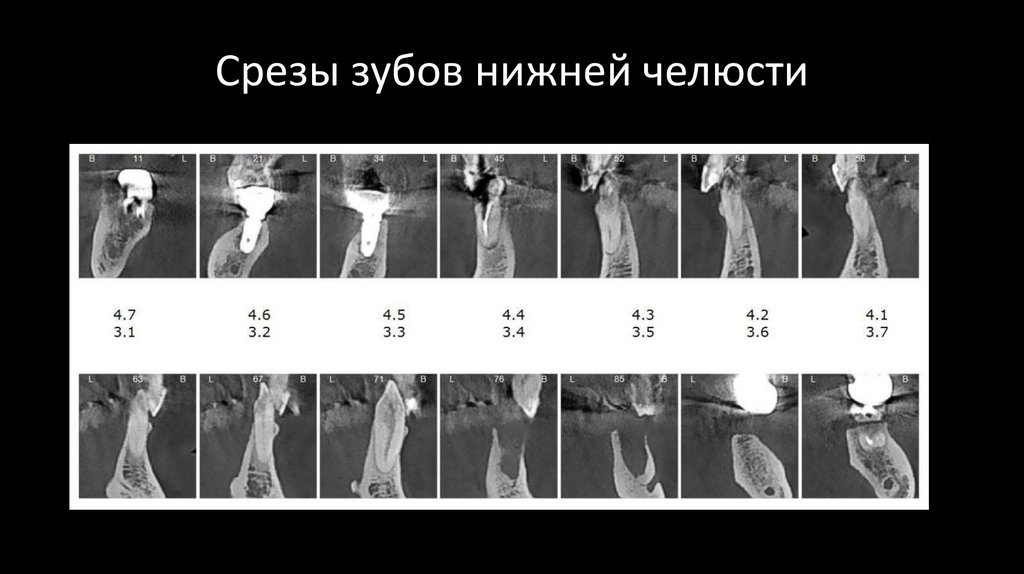 Срезы зубов нижней челюсти