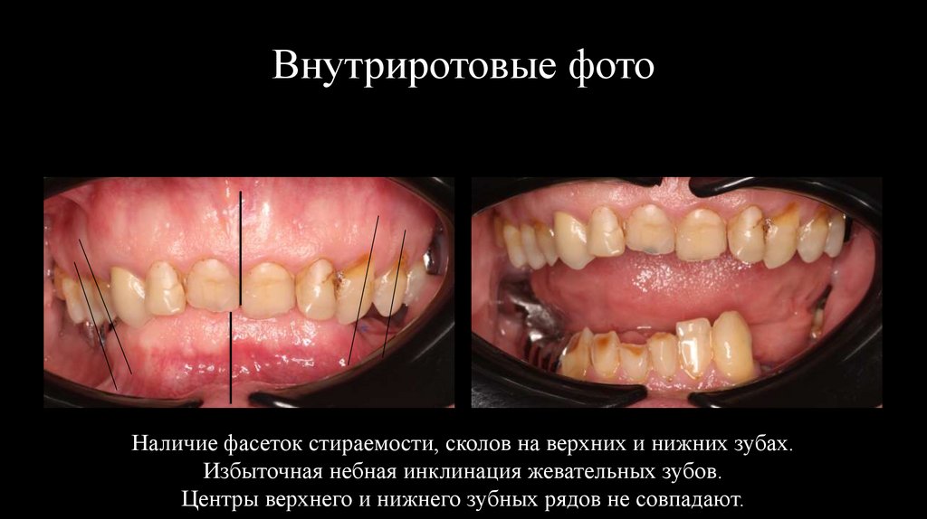 Внутриротовые фото