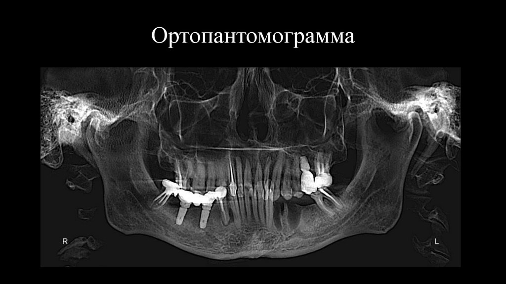 Ортопантомограмма