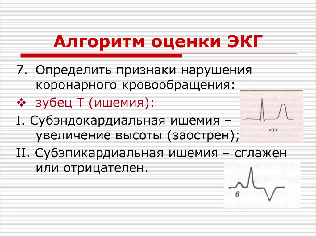 Алгоритм оценки ЭКГ