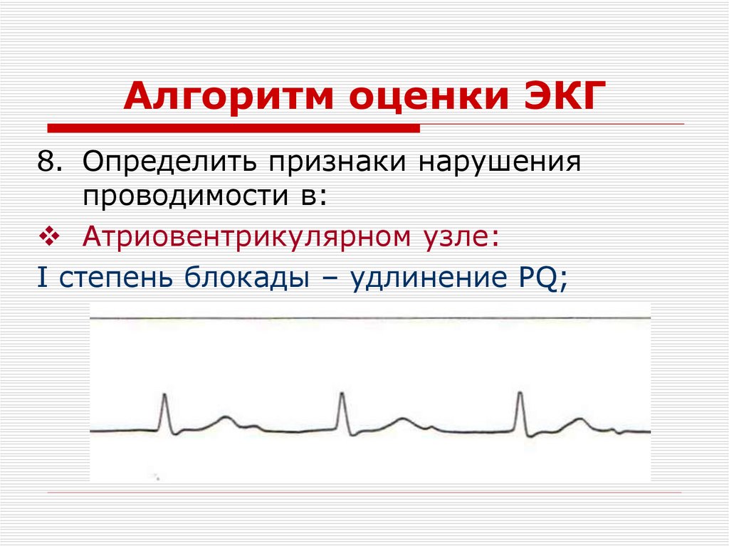 Алгоритм оценки ЭКГ