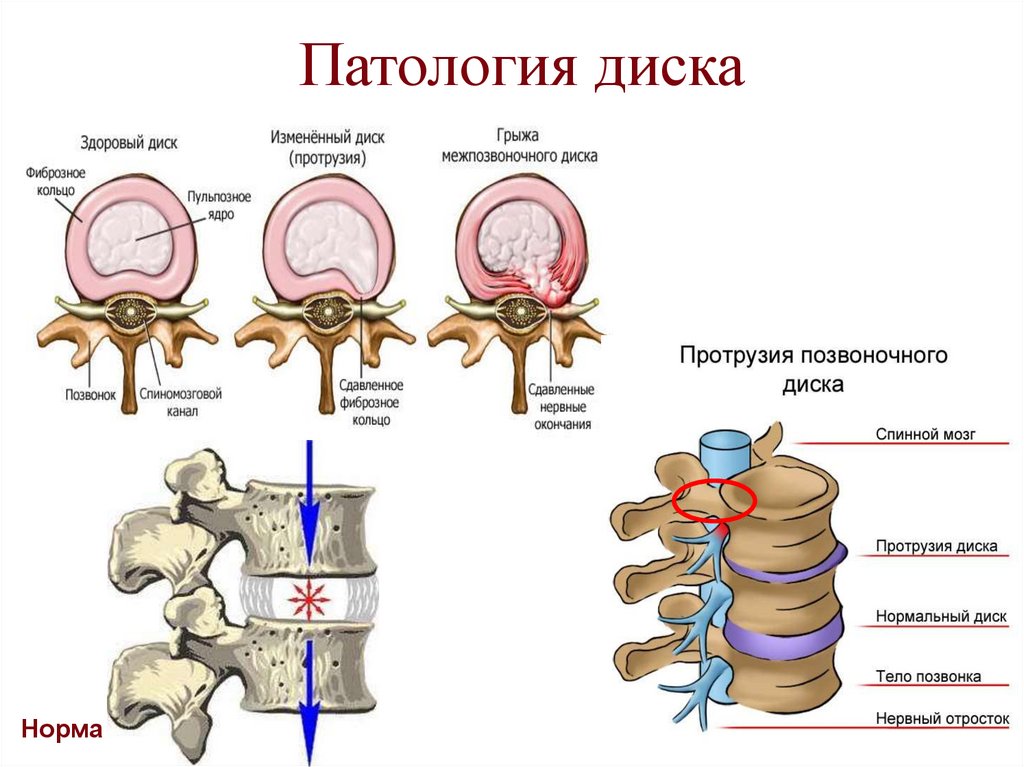 Патология диска