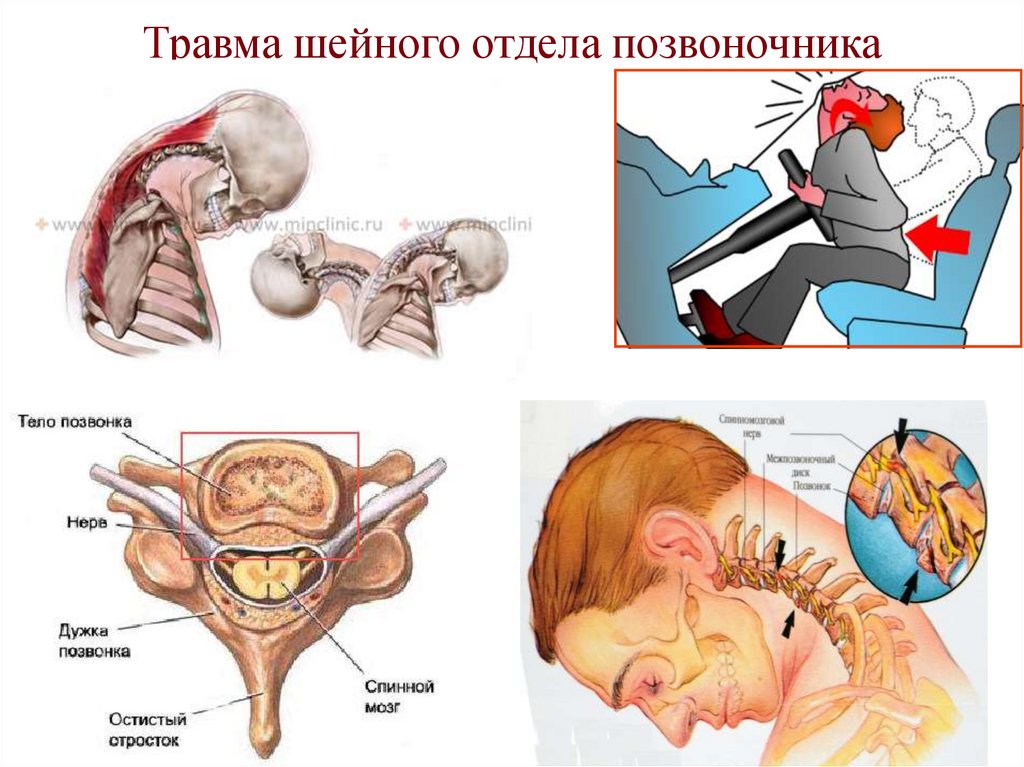 Травма шейного отдела позвоночника