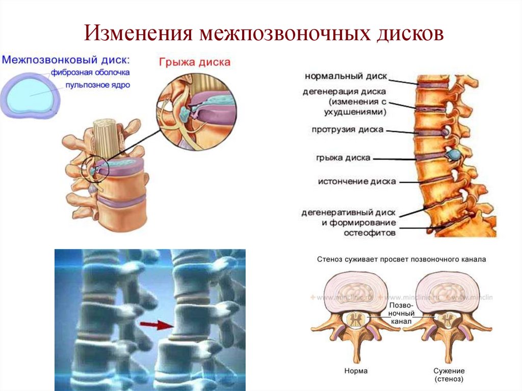 Изменения межпозвоночных дисков