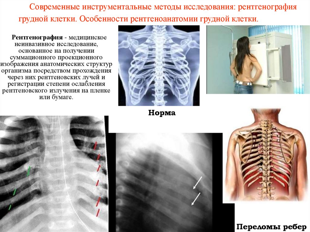 Современные инструментальные методы исследования: рентгенография грудной клетки. Особенности рентгеноанатомии грудной клетки.