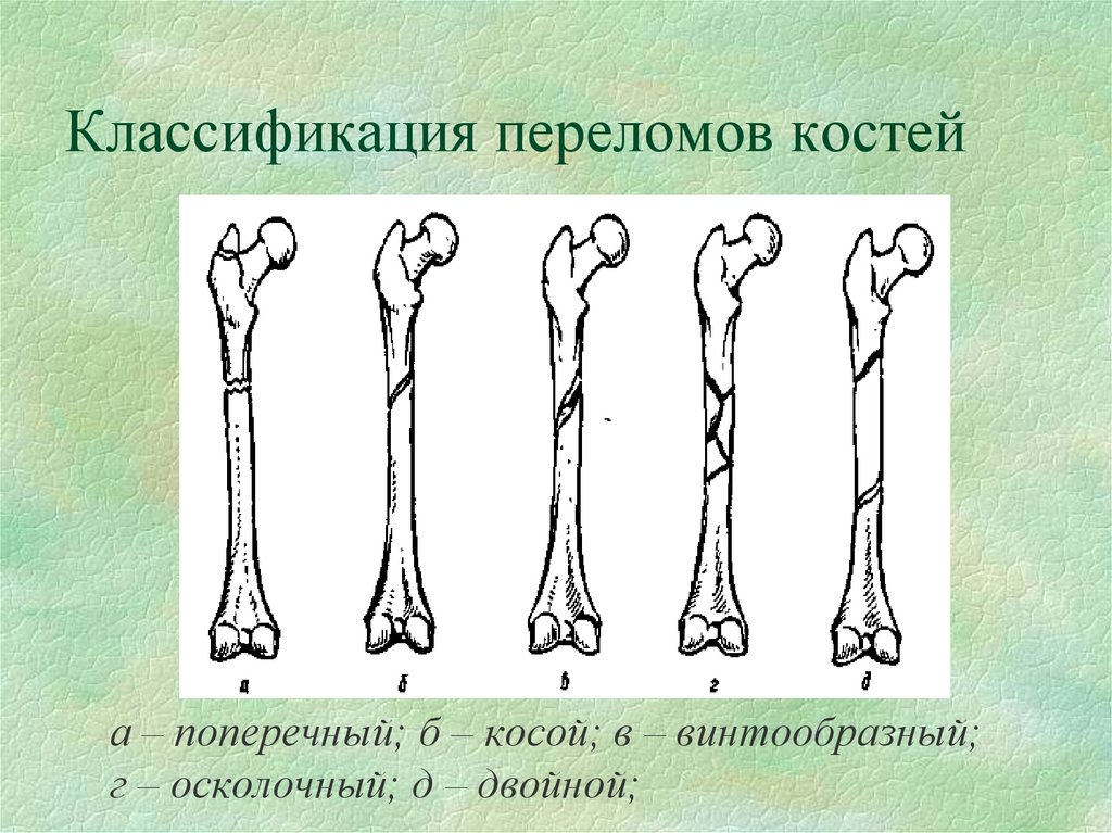 Классификация переломов костей