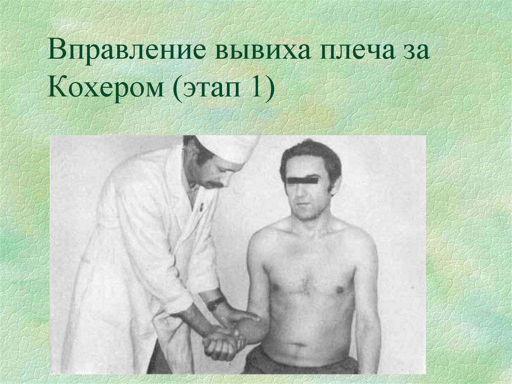 Вправление вывиха плеча за Кохером (этап 1)