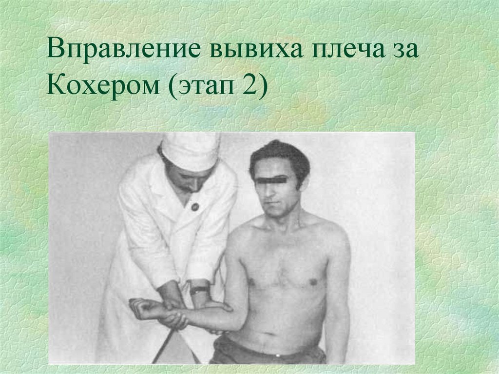 Вправление вывиха плеча за Кохером (этап 2)