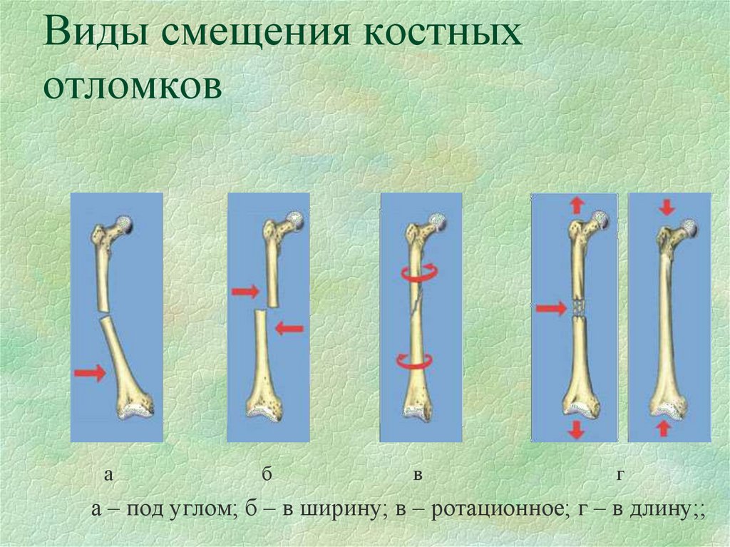 Виды смещения костных отломков