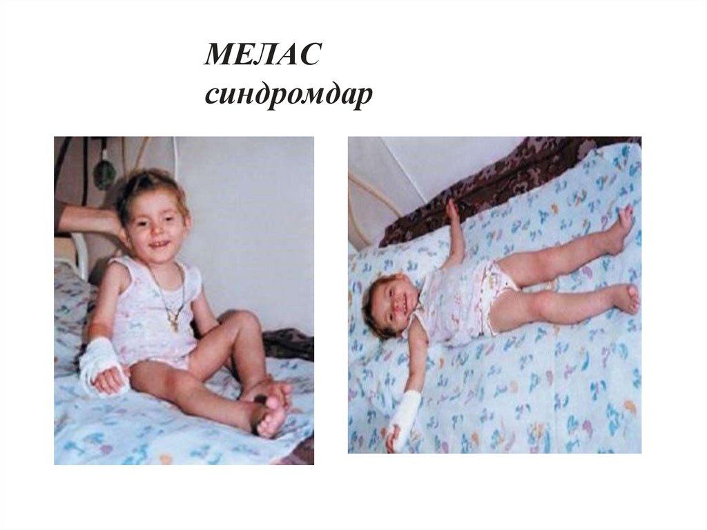 МЕЛАС синдромдар